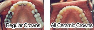 Regular vs Ceramic crowns comparison