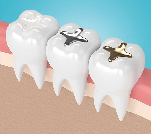 dental fillings animation