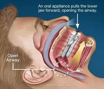 oral appliance diagram