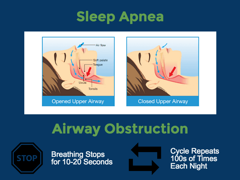 sleep apnea diagram