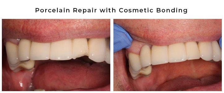 Porcelain Repair with Cosmetic Bonding