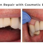Porcelain Repair with Cosmetic Bonding