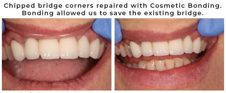 Chipped bridge corners repaired with Cosmetic Bonding.