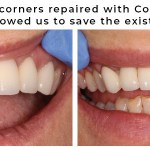 Chipped bridge corners repaired with Cosmetic Bonding.