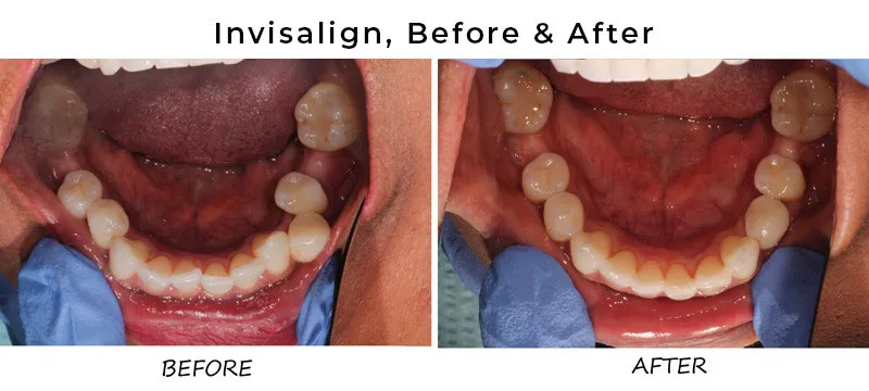 invisalign progress photos