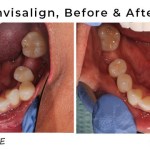 invisalign progress photos