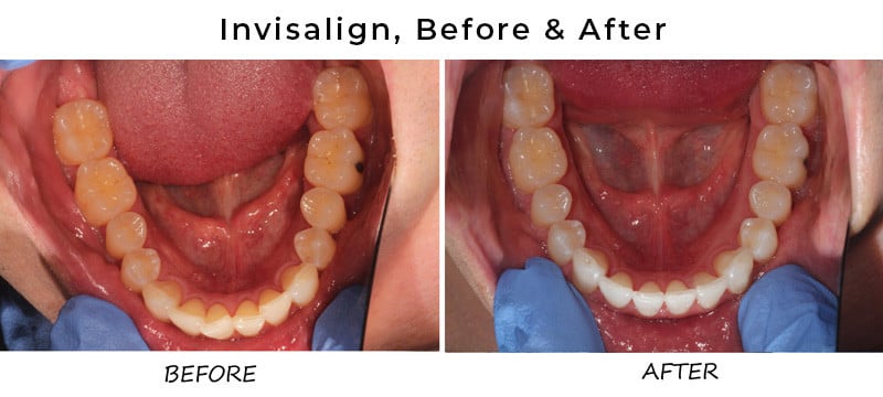 before/after invisalign