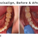 before/after invisalign