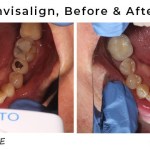 invisalign treatment before and after