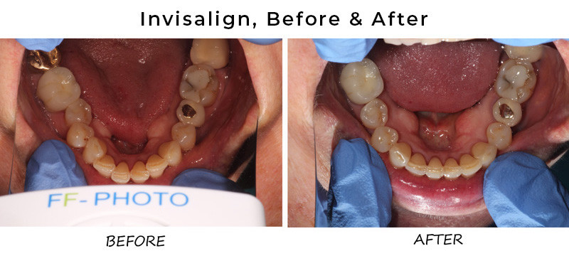 invisalign treatment before and after