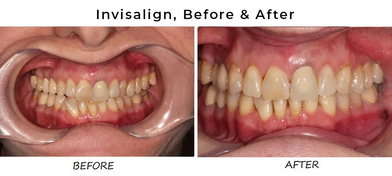 invisalign before and after