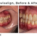 invisalign before and after