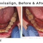 before & after invisalign