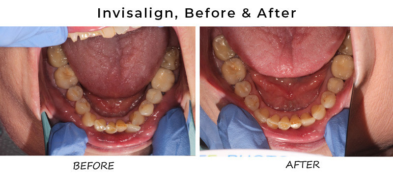 before & after invisalign