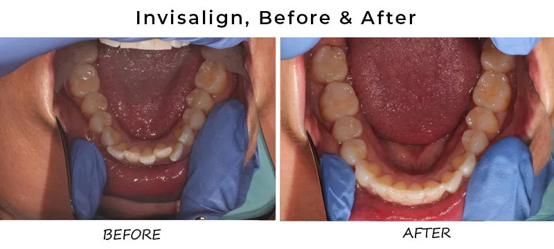 before and after invisalign