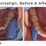 before and after invisalign