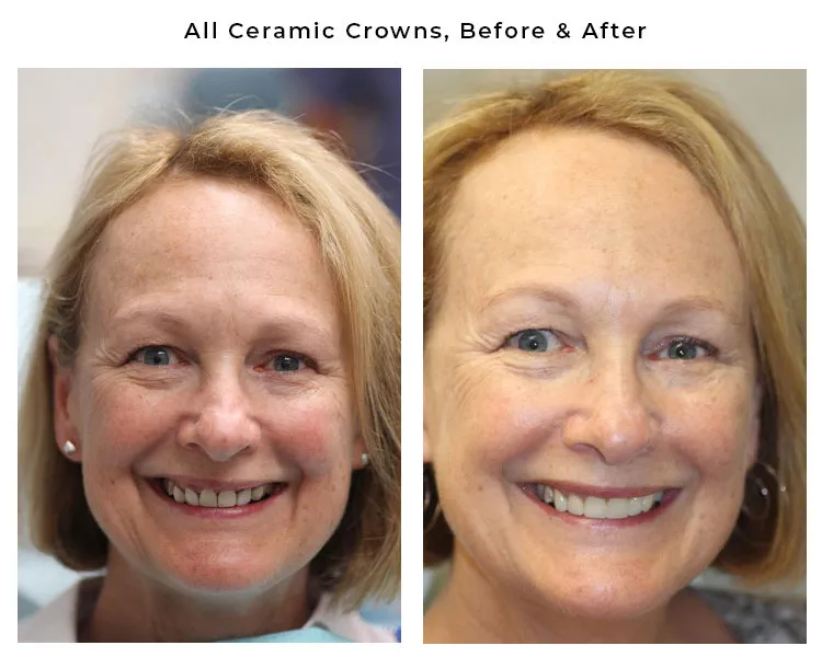 ceramic crown before and after