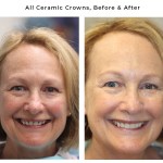 ceramic crown before and after