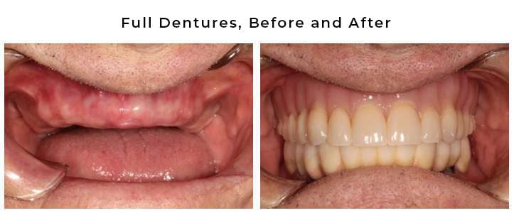 before and after dentures