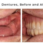 before and after dentures