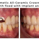 before and after of implant crown