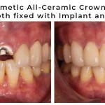 before and after of implant crown