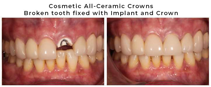 before and after of implant crown