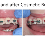cosmetic bonding berfore and after