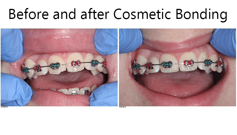 cosmetic bonding berfore and after