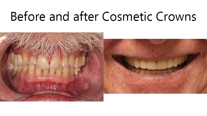 cosmetic crowns before and after