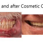 cosmetic crowns before and after