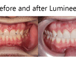 lumineers before and after