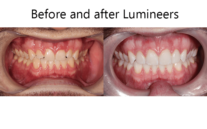 lumineers before and after